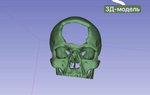 Татарстан табиблары яраланган хәрбинең маңгаен 3D-принтер ярдәмендә төзәткән