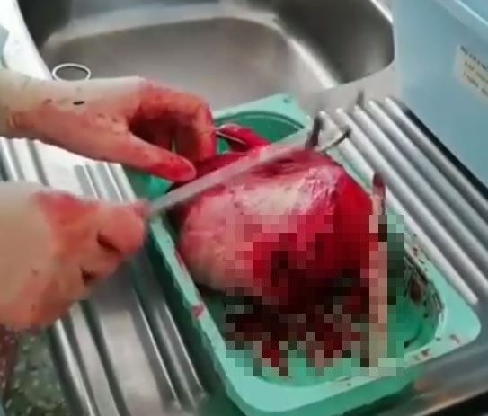 Гинеколог операциядән соң видеоролик төшергән: кеше эченнән бала башы кадәр зурлыктагы, таш кебек каткан киста алынган