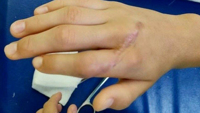 Татарстанда бармагын «болгарка» белән өздергән кызны коткарганнар