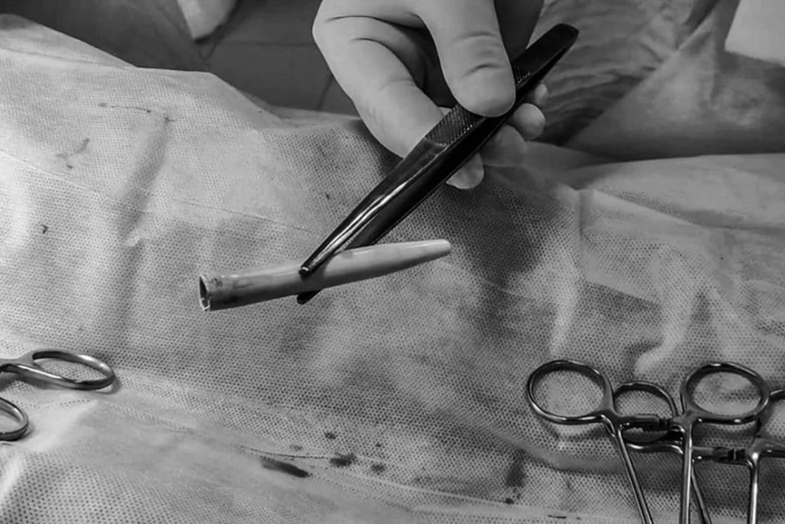 Чаллы табиблары җенес органында ручка кысылып калган егеткә операция ясаган