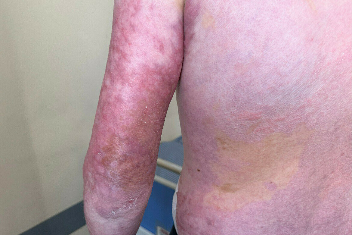 Газ баллоныннан ут капкач, 20 операция белән исән калу тарихы: «Йөрергә яңадан өйрәндек»