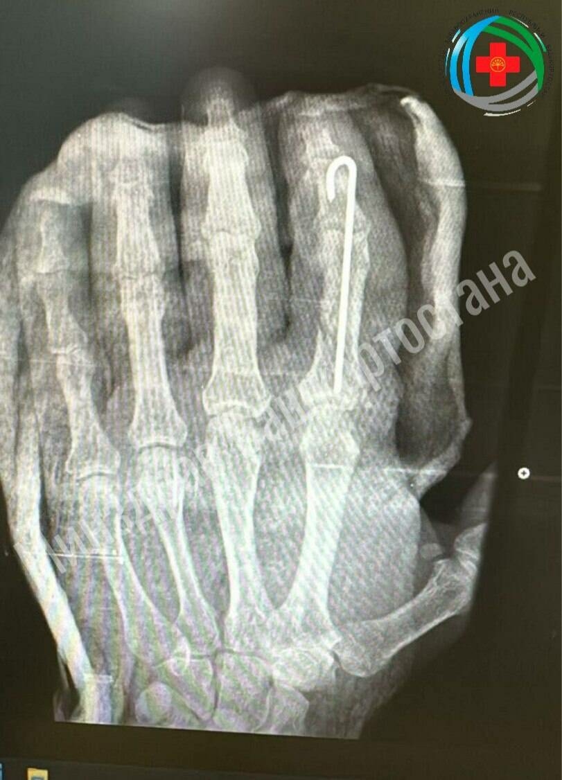 Башкортстанда ир-атның балта белән чабып өзгән бармагын кире тегеп куя алганнар