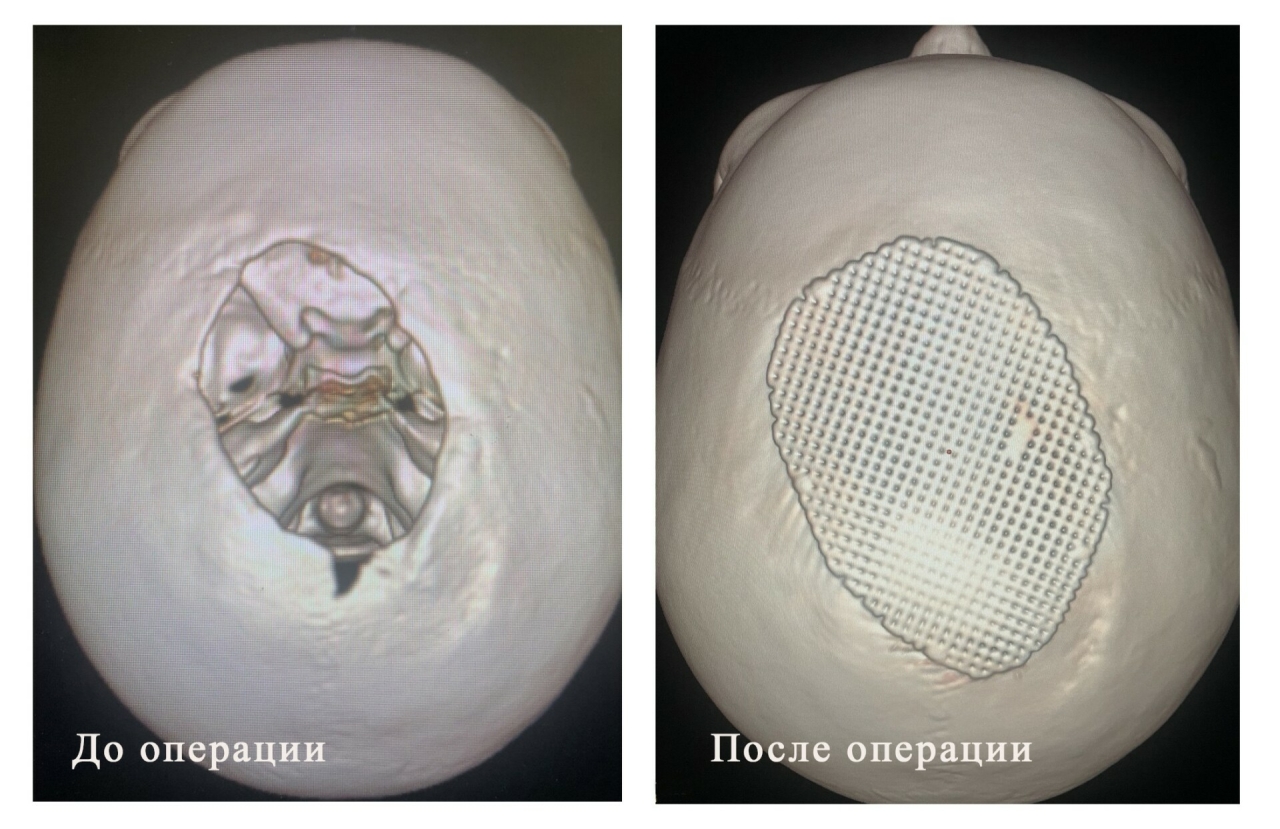 Уйнарга чыгып киткән баланы ток суккан: «Мондый яра белән өлкәннәр дә исән калмый»